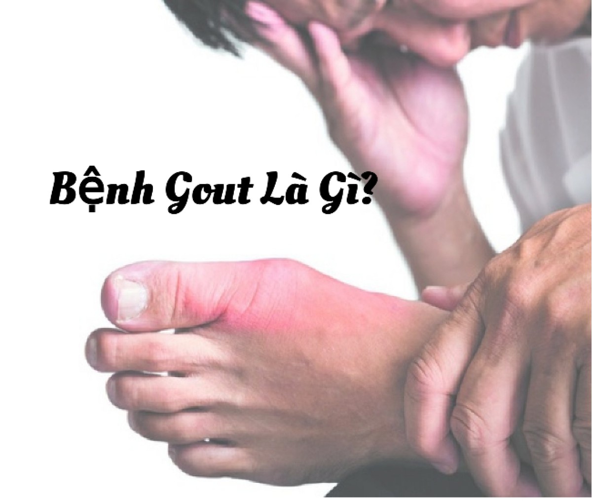 Bệnh Gout Là Gì? Phương Pháp Hỗ Trợ Điều Trị.